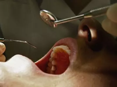 Delhi Dentist Bites