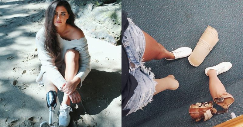 24 Yo Woman Who Lost Her Leg To Cancer Proudly Shows Off Her Stump Giving Us A Lesson In Bravery