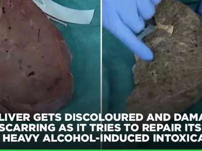 This Shocking Video Reveals How Alcohol Can Wreck A Healthy Liver
