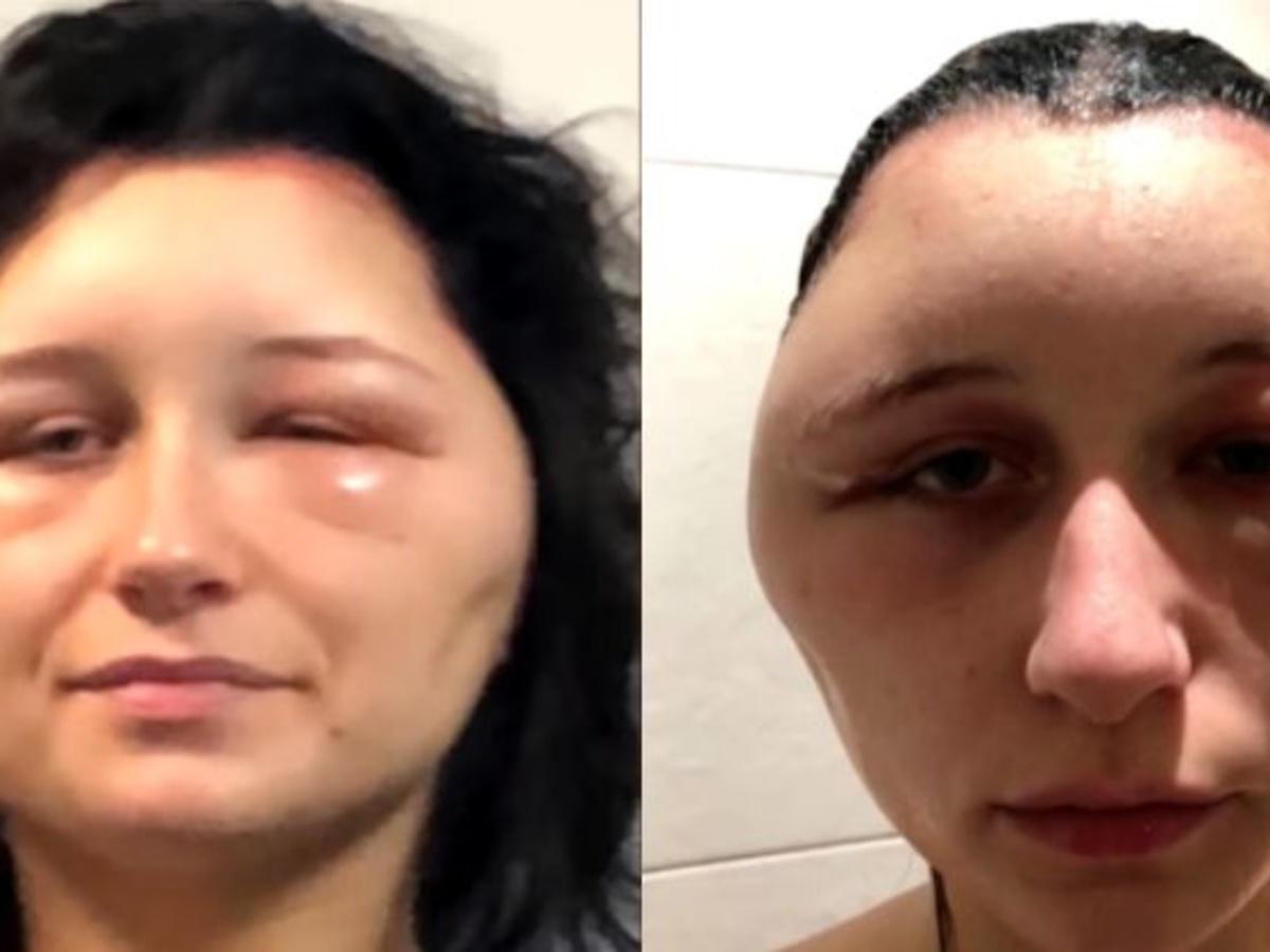 19-Year-Old Left With A Swollen Head After An Extreme Allergic Reaction To  DIY Hair Dye