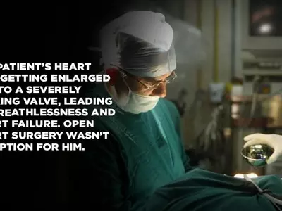 In A First, A Team Of Doctors In Delhi Repair A Leaking Heart Valve Without Surgery