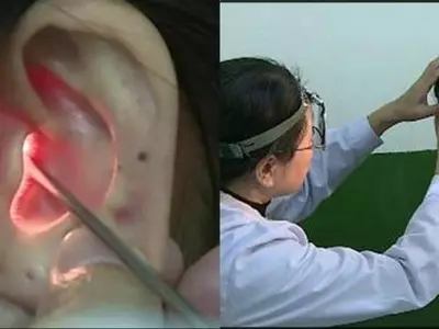 hearing aid, China, Dr Lin Xiaoqing, reverse-slope, diagnosis, symptoms, nausea