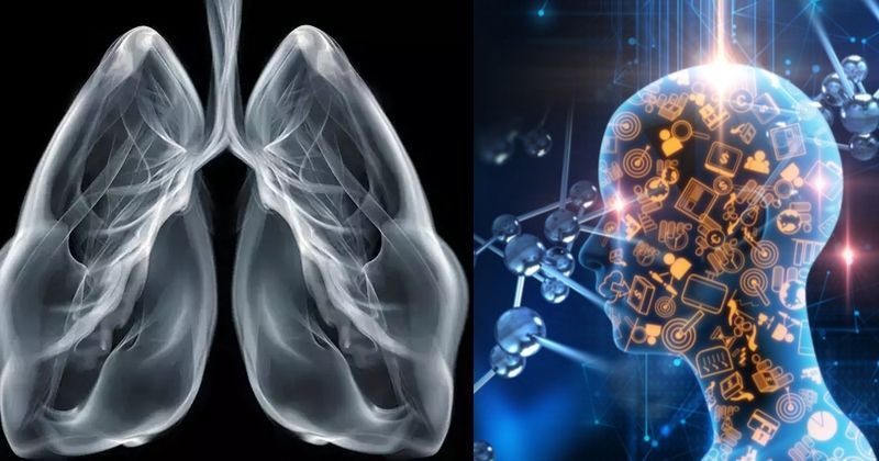 This Image Recognition AI Can Detect Pneumonia From An X-Ray In Just 10