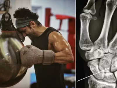 ‘My First Legit Boxing Injury’! Farhan Akhtar Suffers Hairline Fracture On Toofan Sets, Shares Photo