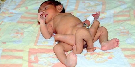 Baby with six legs born in Pakistan