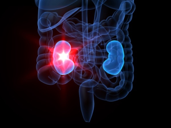 What's Your Risk Of Developing Kidney Failure?