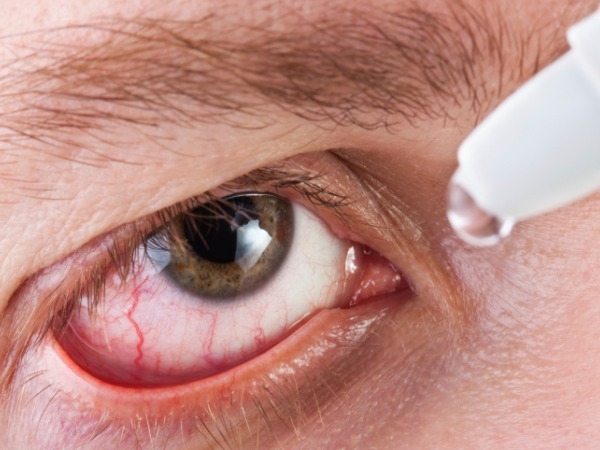 How To Prevent Conjunctivitis This Monsoon