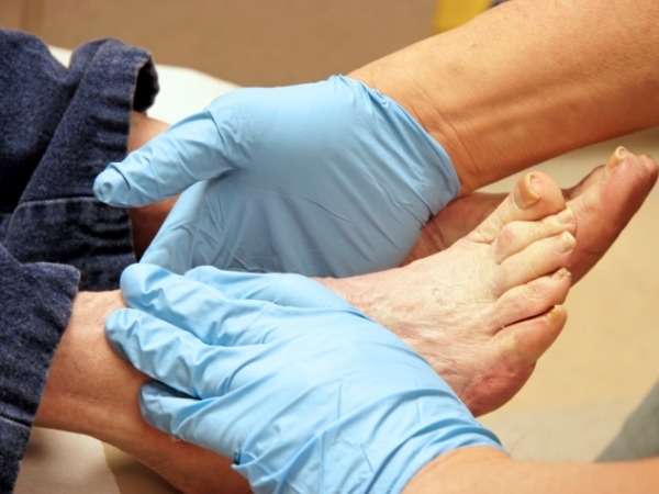 How To Prevent Diabetes-Related Foot Problems