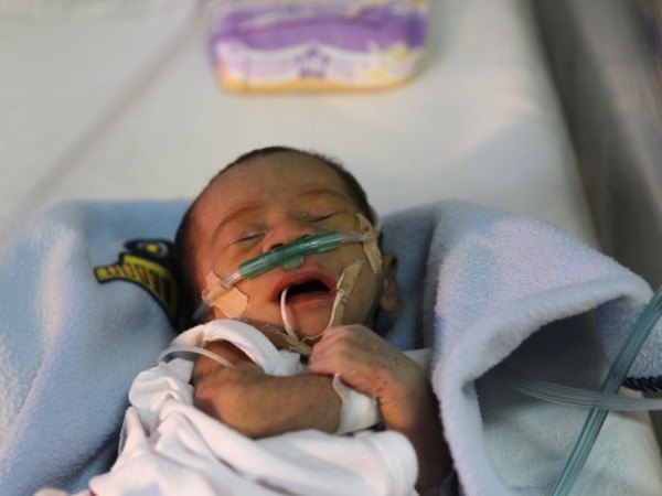 Prevent Pneumonia To Lower Infant Mortality Rate: India