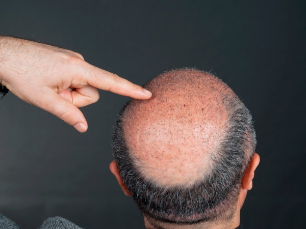 All You Need To Know About Hair Transplant Procedures