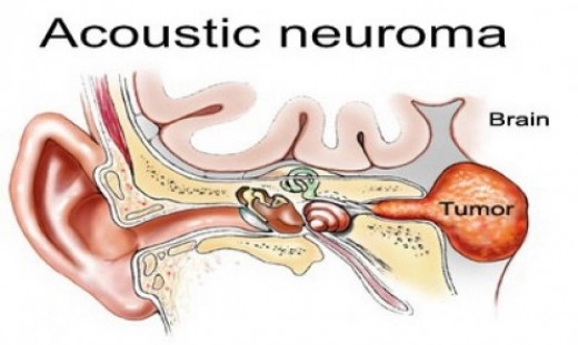 What Is Acoustic Neuroma, Causes And Treament