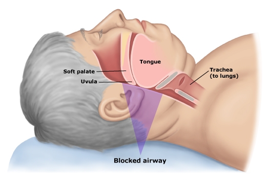 Obstructive Sleep Apnea Treatment: Transoral Robotic Surgery