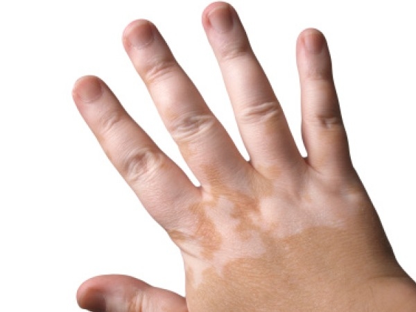 Skin Problems What Is Vitiligo Causes Myths And Treatment Healthy Living