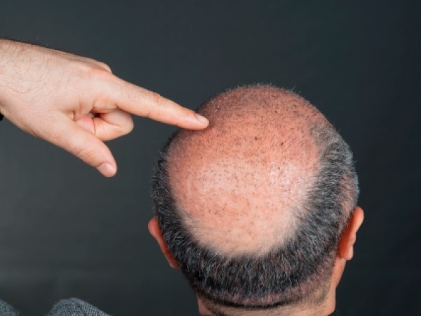 Hair Care: Hair Treatments To Fight Baldness In Men