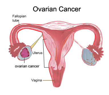 Cancer Prevention: What Is Ovarian Cancer?