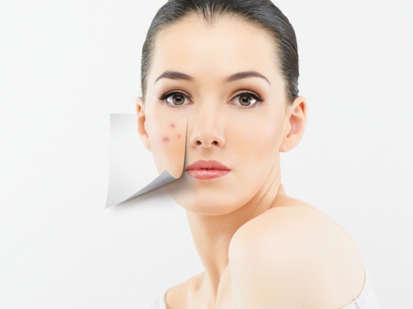 Adult Acne: Causes And Treatments