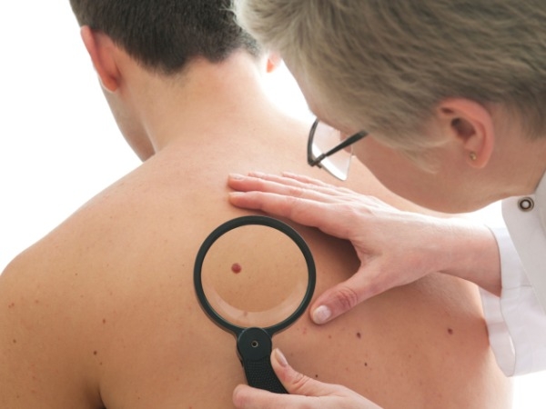 You Ask, We Answer: How to Differentiate Moles from Cancerous Moles?