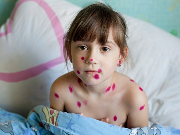 Chicken Pox Causes Symptoms And Treatments Healthy Living