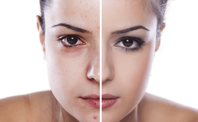 13 Natural Secret Ways To Get Rid of Acne Forever!