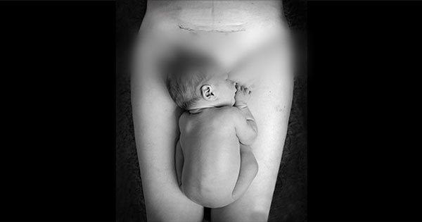 Cesarean childbirth