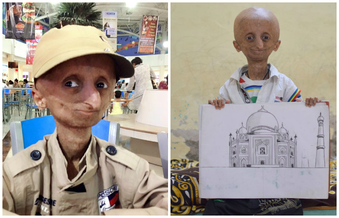 He Suffers From Progeria And Won
