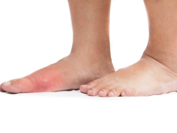 Uric Acid Levels: Symptoms Of Gout