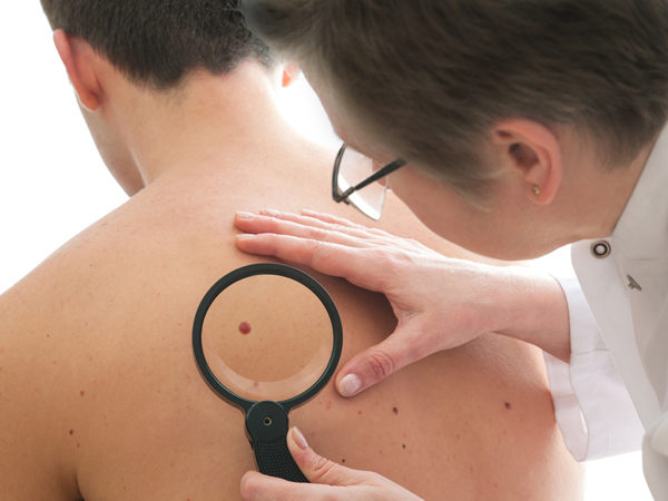 Skin Cancer Risks