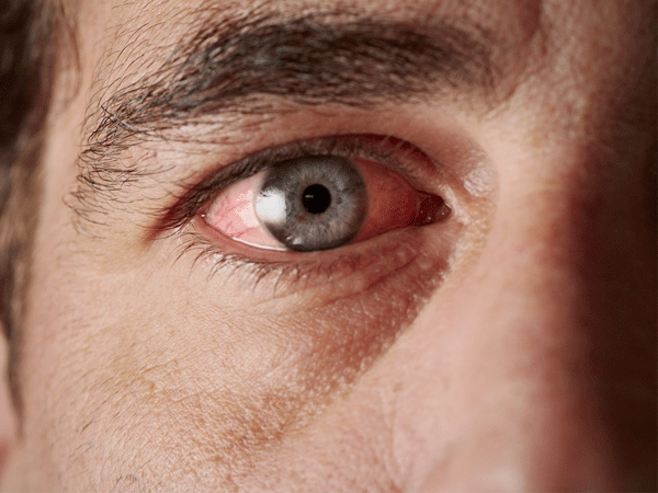 Blood Shot Eyes? It Could Be Ocular Rosacea