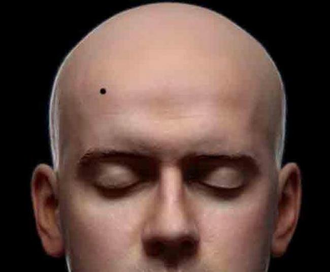 mole on the forehead