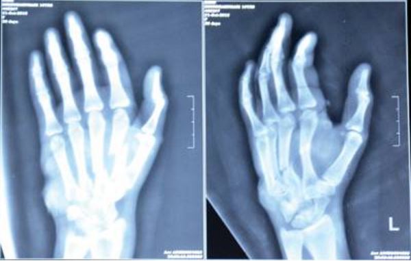 hand fracture