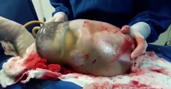baby born inside amniotic sac
