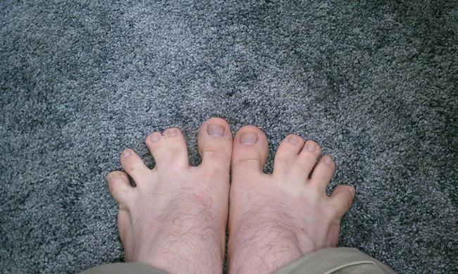 webbed feet human