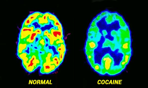 Cocaine Brain Damage