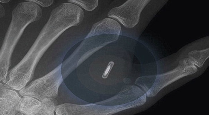 Workers In Sweden Are Becoming Cyborgs With Microchip Implants