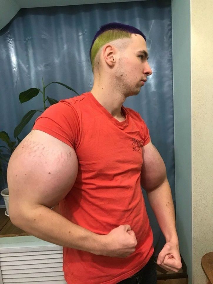 Remove This Stuff Before It Kills You”: Russian 'Popeye' Proudly Bracing  His Synthol-Induced 24-Inch Freakish Biceps Leaves Fitness World Concerned  - EssentiallySports