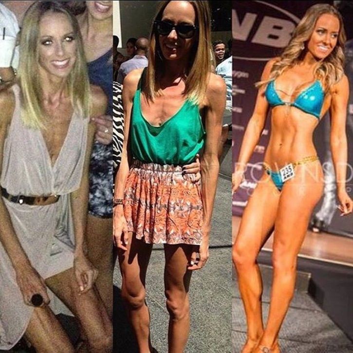 These Before And After Images Of People Who Overcame Anorexia Is Nothing Short Of Inspirational