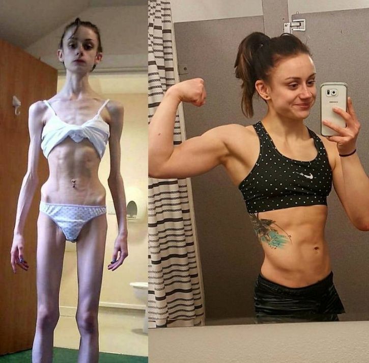 These Before And After Images Of People Who Overcame Anorexia Is Nothing Short Of Inspirational