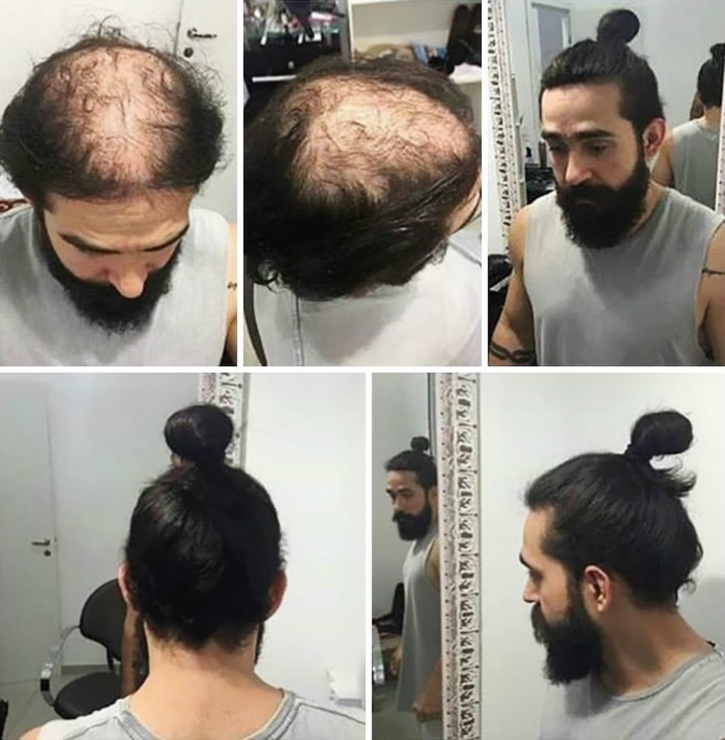 Hiding That Bald Patch With A Man Bun? Well, You Could Be Risking Losing  More Hair