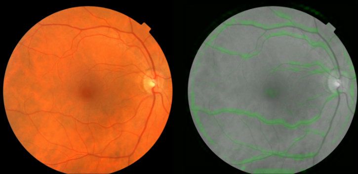 The retina scans being assessed by Google