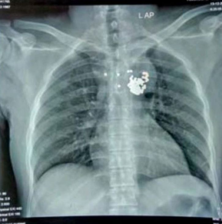 97 Pellets Removed From Man Chest