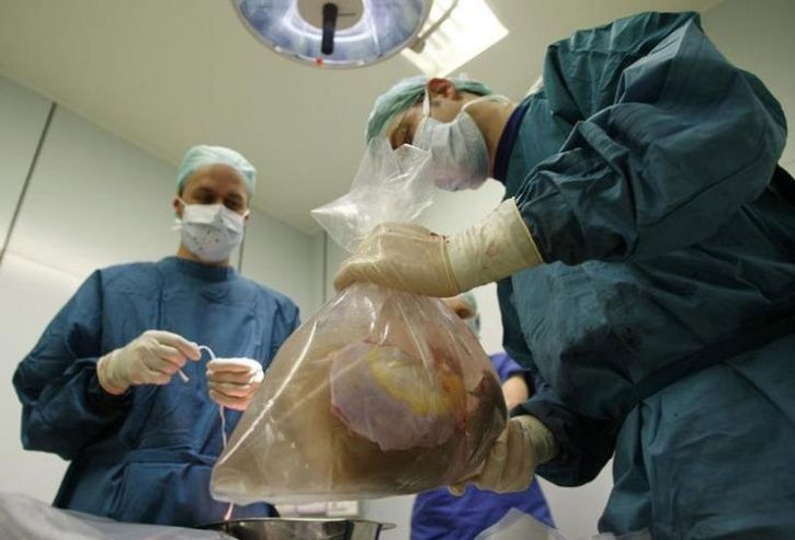 Hospital Removes 856 Stones From Man’s Kidney