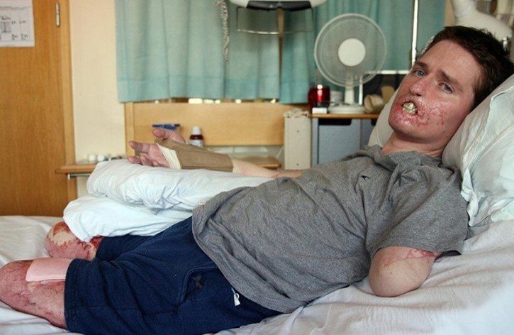 This Man Who Lost His Limbs And Lips Gets A New Set Of Lips In A First Of Its Kind Surgery