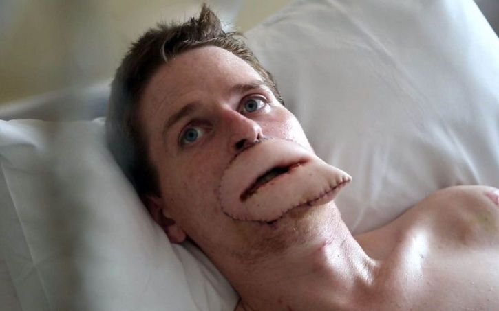 This Man Who Lost His Limbs And Lips Gets A New Set Of Lips In A First Of Its Kind Surgery