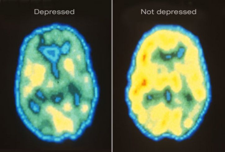 Ever Wondered What Causes Depression In Your Brain? There’s A Pattern That Might Be Behind It