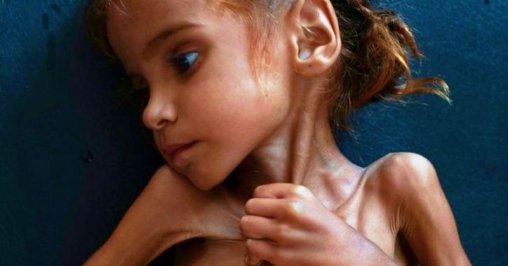 Starving Yemen Girl Who Turned World’s Eyes Towards Famine & Became Symbol Of Crisis Is Dead