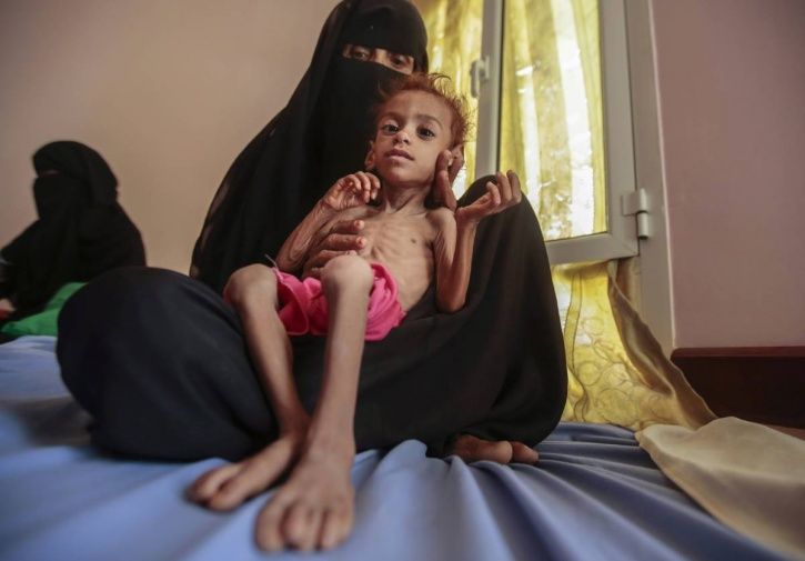 Starving Yemen Girl Who Turned World’s Eyes Towards Famine & Became Symbol Of Crisis Is Dead