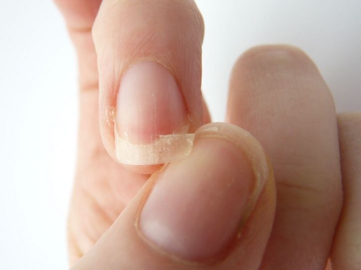 7 Health Conditions Your Nails Are Trying To Warn You Of