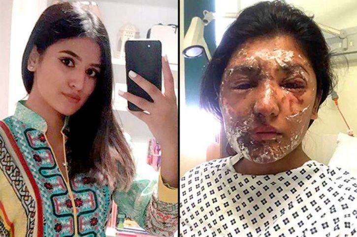 women who survived acid attack