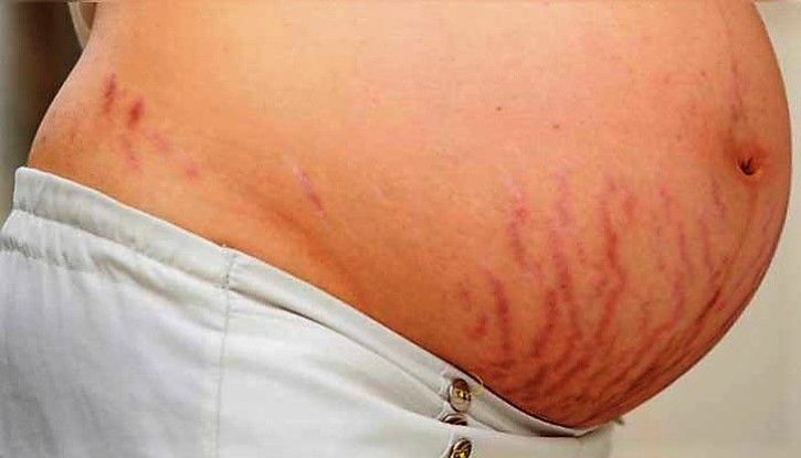 difference between red stretch marks and white stretch marks