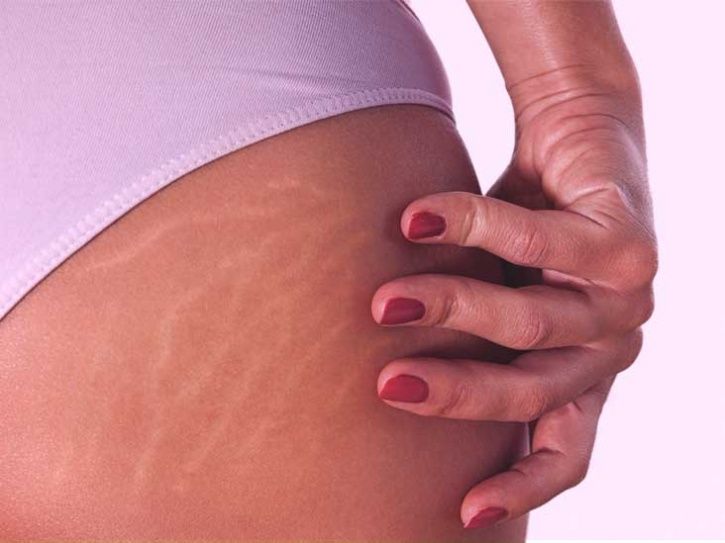 difference between red stretch marks and white stretch marks